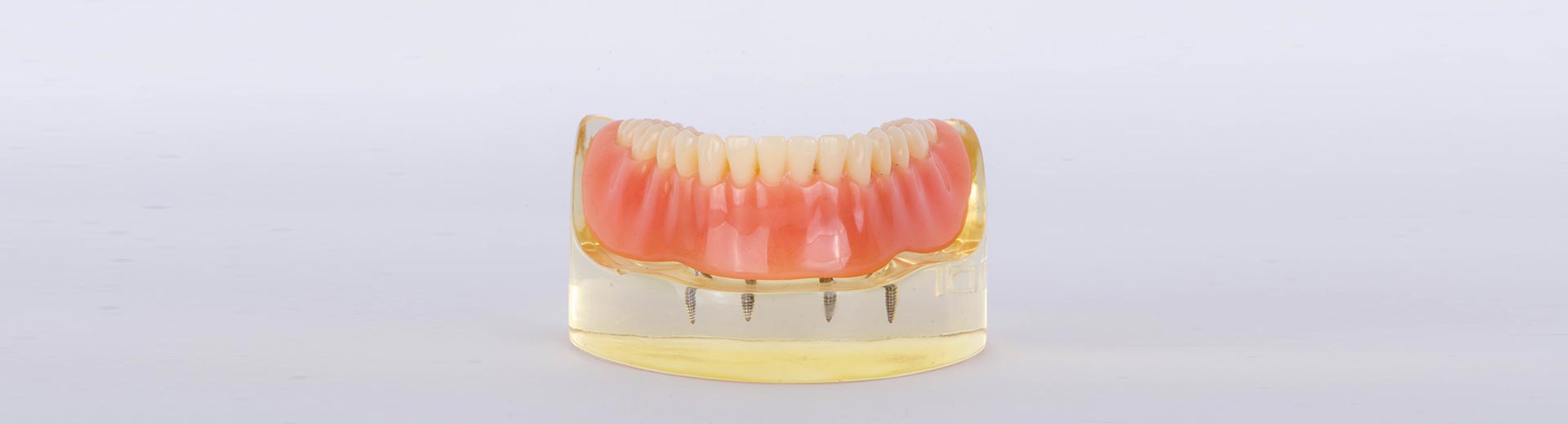 Implant retained dentures
