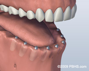 A mouth that has six implants and no teeth on its lower jaw