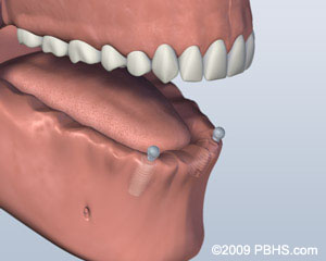 A mouth with the lower jaw with two implants and no bottom teeth